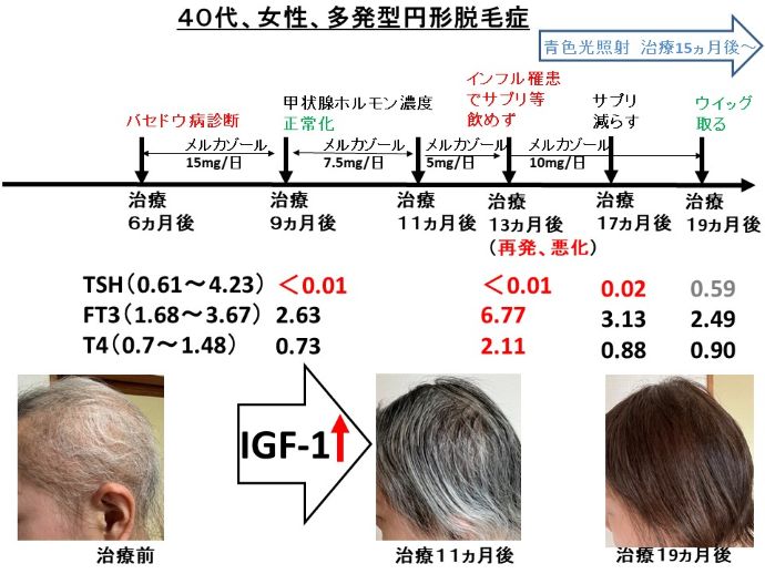 円形脱毛症　病院
